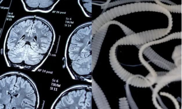 寄生虫警告？！美国一男子大脑中发现大量寄生虫卵，病因竟然是因为吃培根？？？