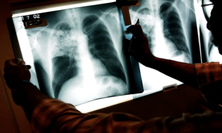 注意！ 美国多州报告肺结核爆发病情，已造成多人感染，卫生部门宣布进入经济状态！